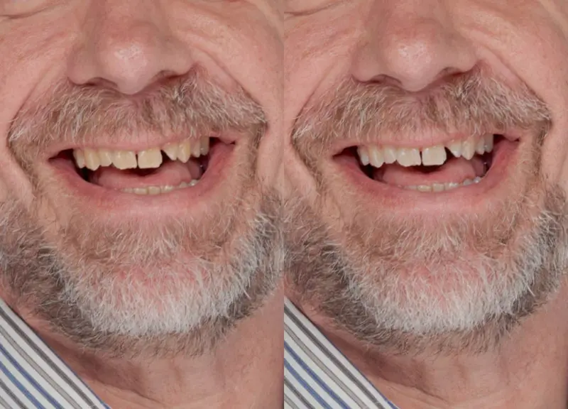 before and after teeth whitening