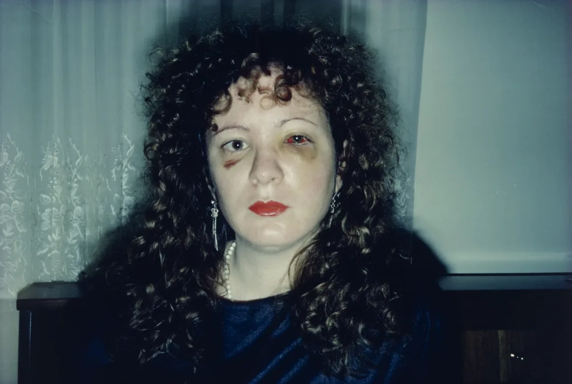 Nan One Month After Being Battered 1984