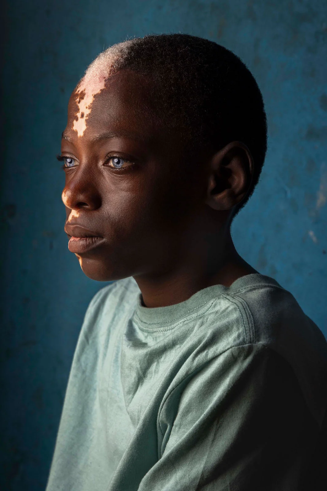 Sony World Photography Awards 2027’ye Katılmanız İçin 15 İlham Verici Fotoğraf 31 A young boy with dark skin and striking blue eyes, featuring a patch of vitiligo on his forehead and hair, looks to the side.